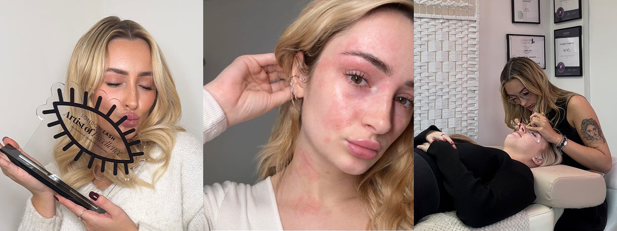 Plot Twist: I Developed an Allergy to My Own Profession